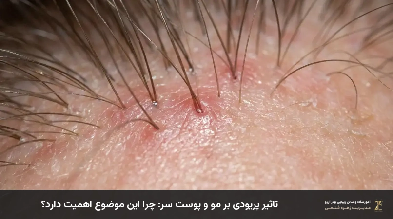تاثیر پریودی بر مو و پوست سر: چرا این موضوع اهمیت دارد؟